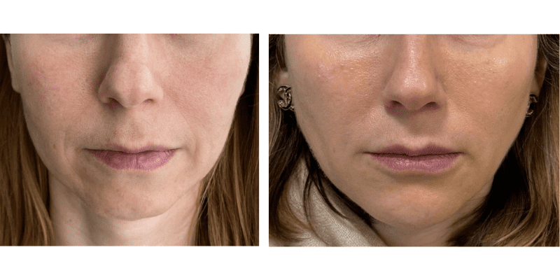 Sculptra Before and After: Natural Volume and Skin Firmness Without Fillers