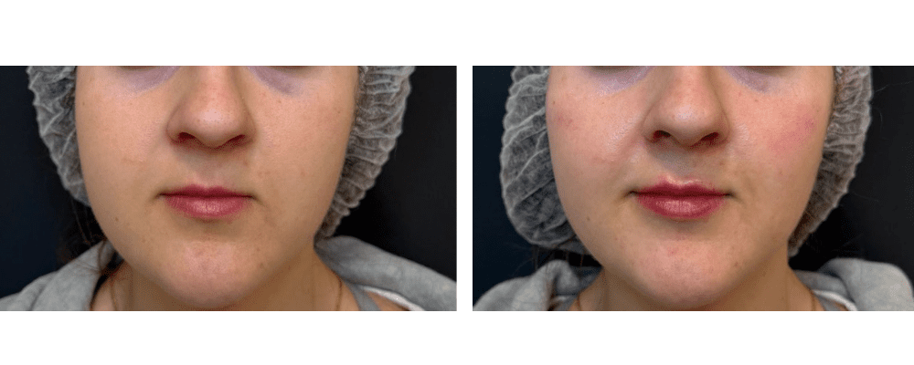 Natural Lip Fillers: What to Request for Subtle, Balanced Results