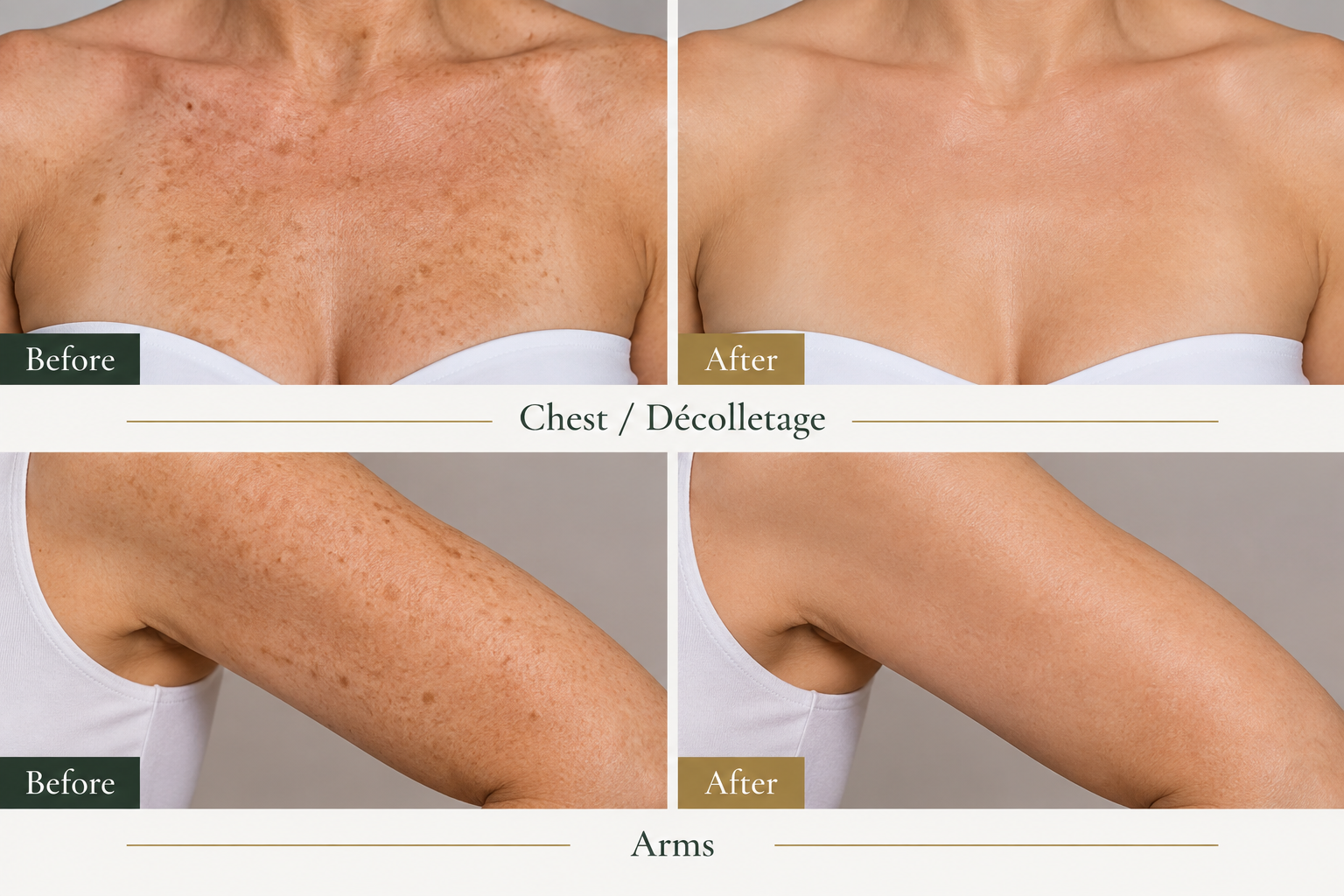 Illustrative before and after comparison showing pigmentation on the chest and arms