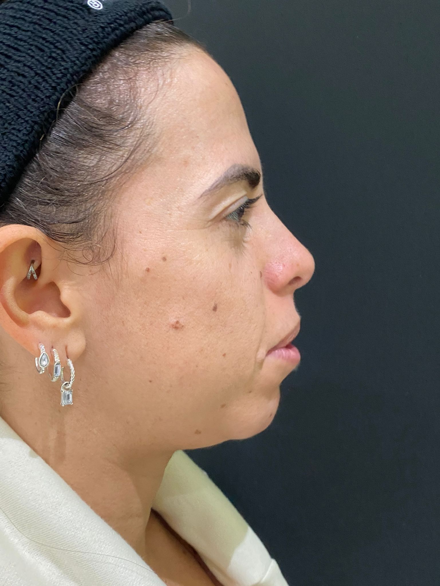 5- Dermal filled before 5- Dermal filled before