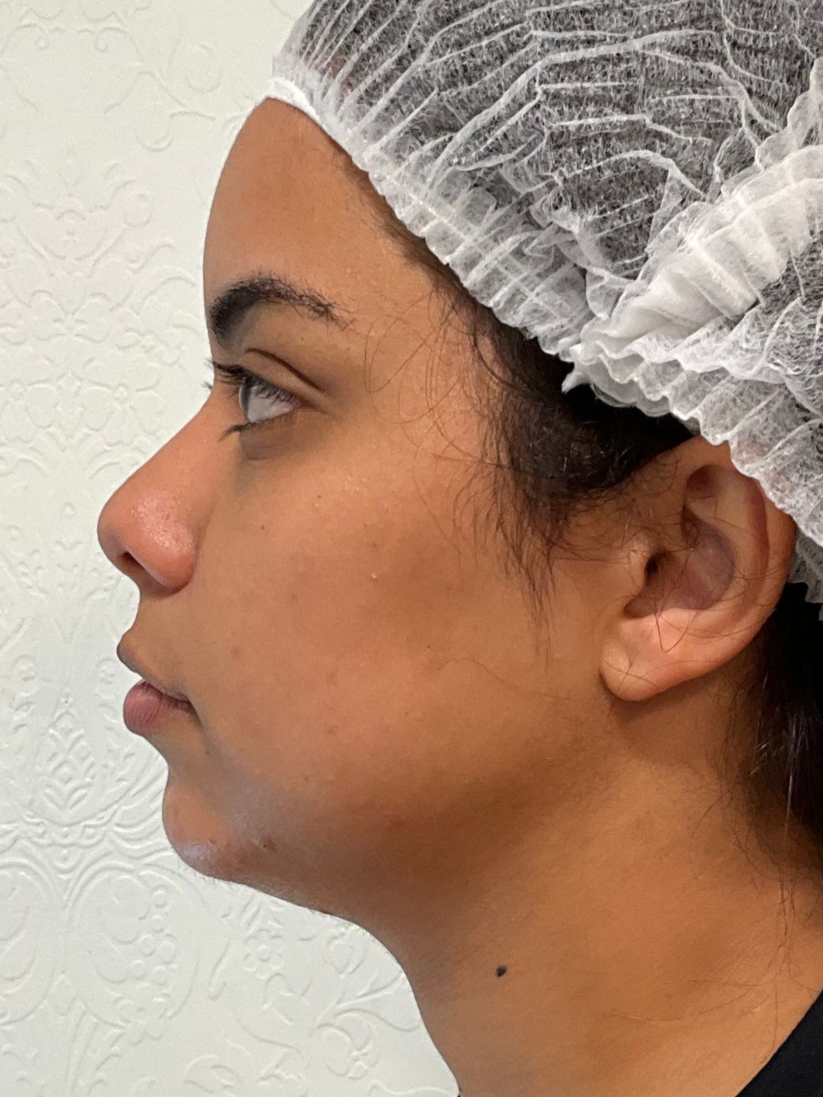 Chin Dermal filler BEFORE Chin Dermal filler BEFORE