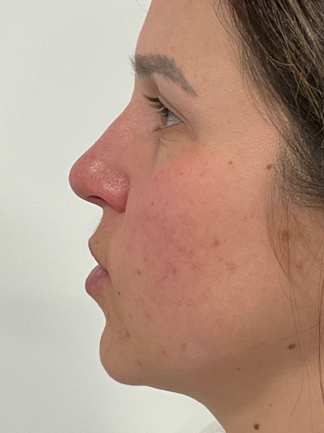 Nose and chin Dermal filler before Nose and chin Dermal filler before