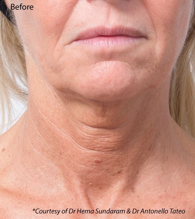 Sculptra before Sculptra before